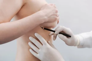 Mastopexia sem protese o que é,benefícios e técnicas 2025