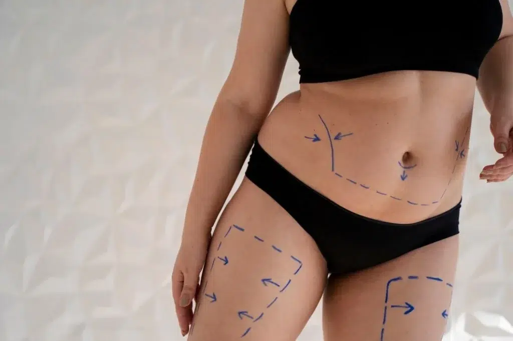 Lipoaspiração Preço