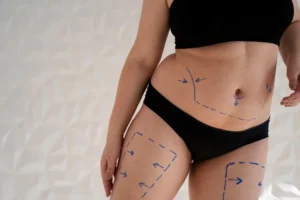 Lipoaspiração Preço: Tudo o que você precisa saber 2025