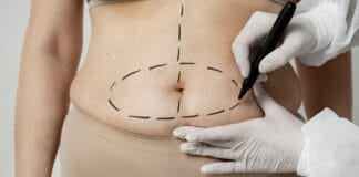 A MILA é eficaz na remoção de estrias ou flacidez extrema?