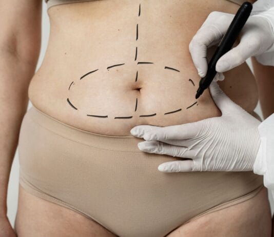 A MILA é eficaz na remoção de estrias ou flacidez extrema?