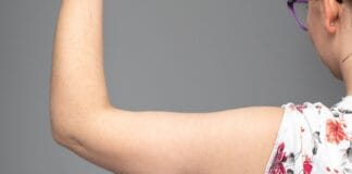 Argoplasma para flacidez severa funciona? Veja os Resultados