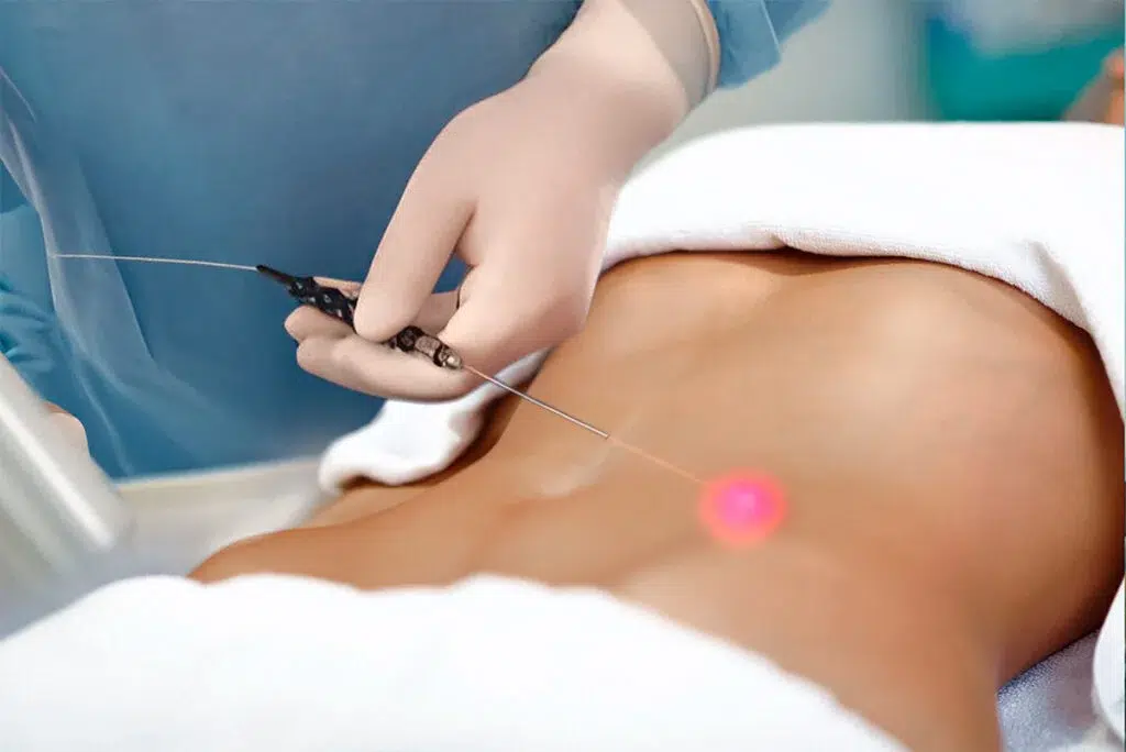 lipoaspiração a laser