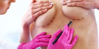 Mamoplastia redutora deixa cicatriz? 2.0