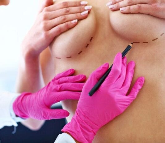 Mamoplastia redutora deixa cicatriz? 2.0