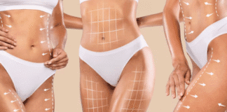 Quais áreas do corpo são tratadas com a lipoabdominoplastia MILA?