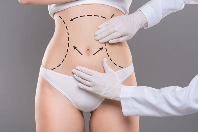 Qual-a-diferenca-de-abdominoplastia-e-Lipoabdominoplastia.jpeg