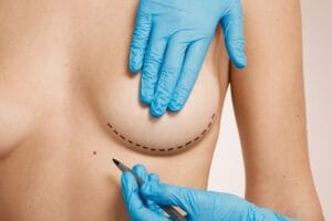 Qual o tempo de recuperação de uma mamoplastia redutora?