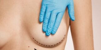 Qual o tempo de recuperação de uma mamoplastia redutora?