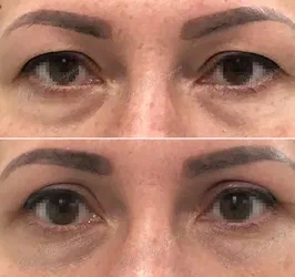 blefaroplastia