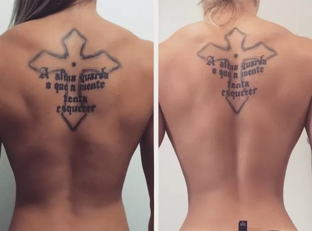 Cirurgia para afinar a cintura