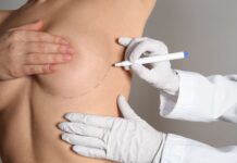 A mamoplastia de recuperação rápida é segura?