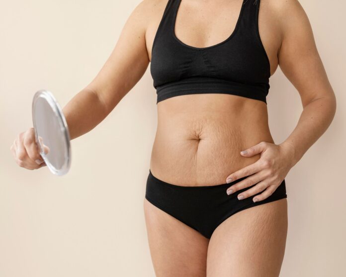 Beneficios-da-lipoabdominoplastia-minimamente-invasiva-MILA.jpg