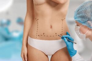 Como funciona a recuperação da lipoabdominoplastia MILA? 2026