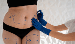 Entenda como e o procedimento da cirurgia Mila