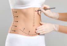 Entenda como é realizada a abdominoplastia Mila