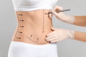 Entenda como é realizada a abdominoplastia Mila