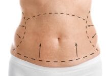 Entenda como funciona o procedimento da abdominoplastia