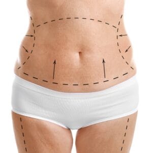 Entenda como funciona o procedimento da abdominoplastia