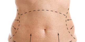 Entenda como funciona o procedimento da abdominoplastia