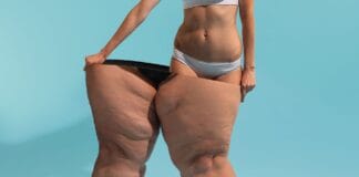 Entenda o que é e como funciona a mini Lipo Laser