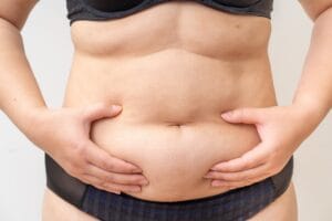 O que é a abdominoplastia? Conheça os detalhes do procedimento