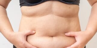 O que é a abdominoplastia? Conheça os detalhes do procedimento