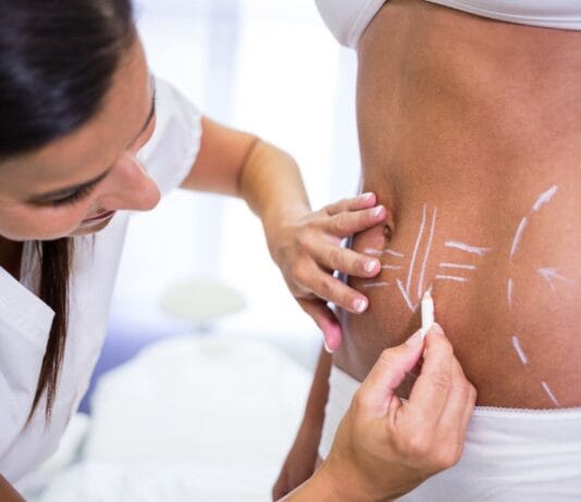 Onde realizar lipoaspiração a laser em São Paulo