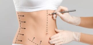 Lipoaspiração a Laser em SP